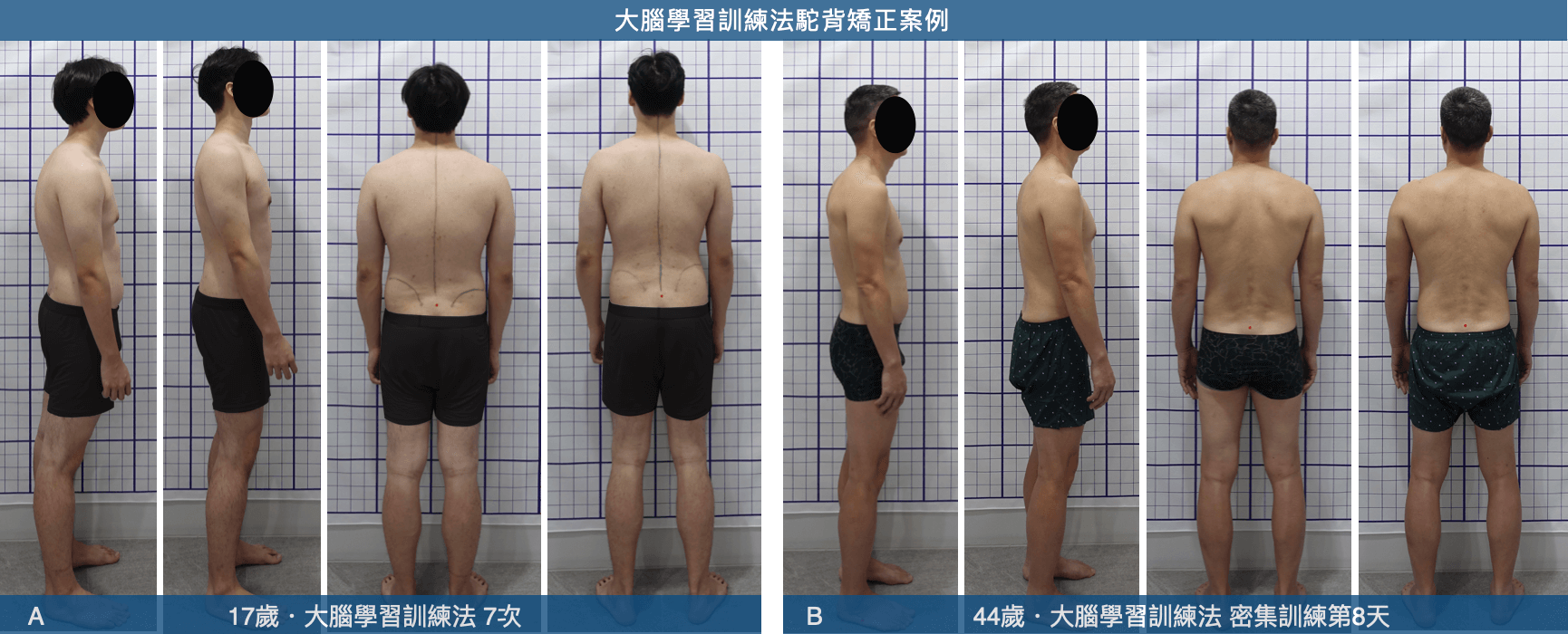 大腦學習訓練法矯正駝背案例