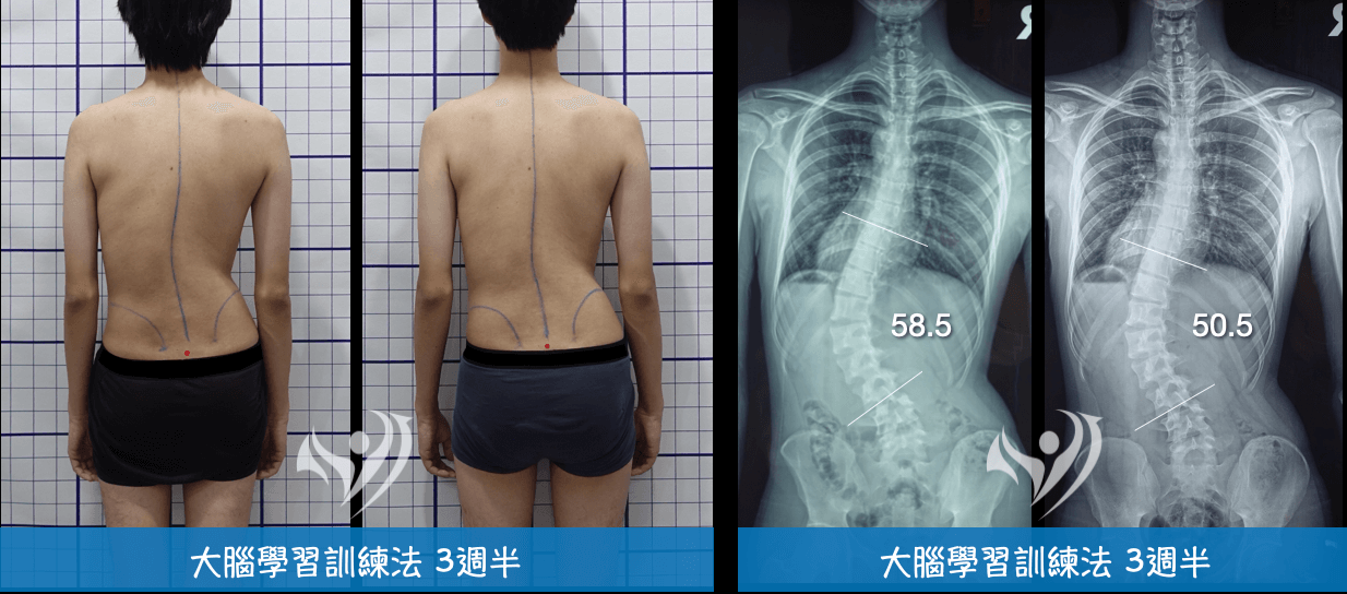 大腦學習訓練法3.5週改善19歲重度側彎及駝背