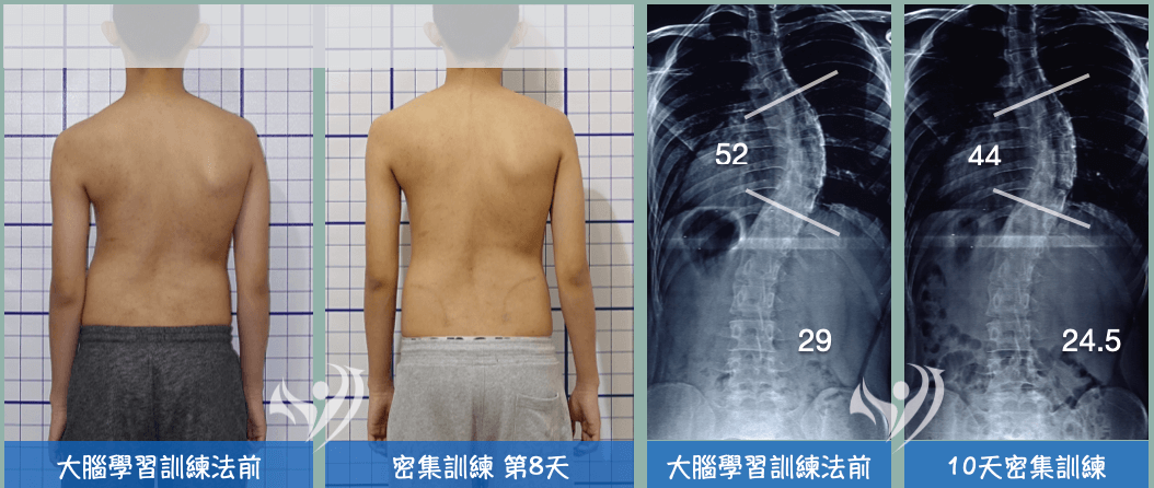 大腦學習訓練法10天短期密集訓練改善重度胸椎側彎，不利用背架改善側彎度數