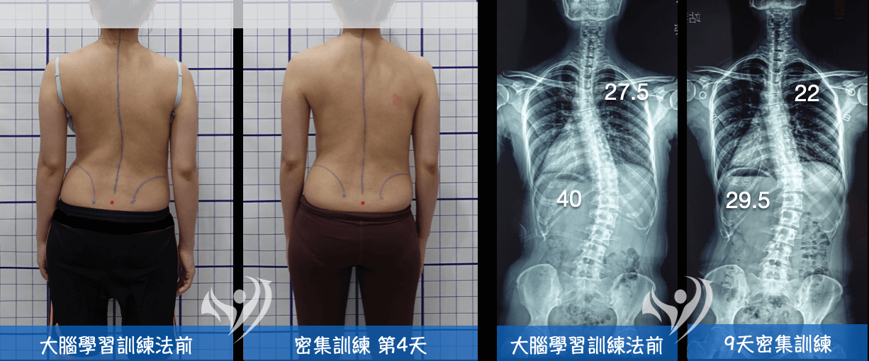 大腦學習訓練法改善成人側彎度數與姿勢外觀