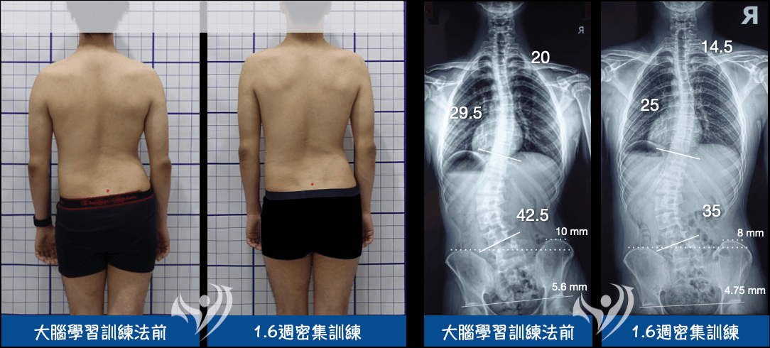 1.6週大腦學習密集訓練改善腰椎側彎、假性長短腳及骨盆歪斜