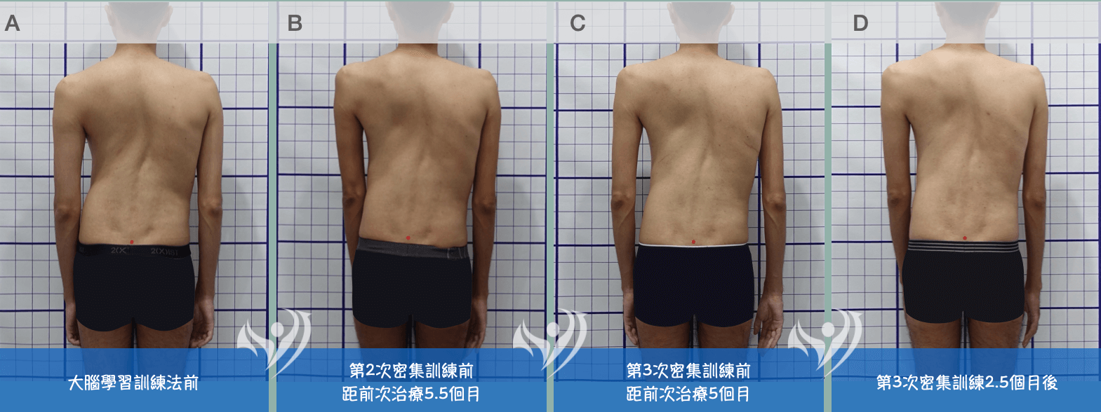 重度胸椎側彎追蹤一年2個月共3次密集訓練成效