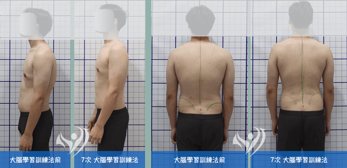 大腦學習訓練法7次矯正駝背姿勢不良