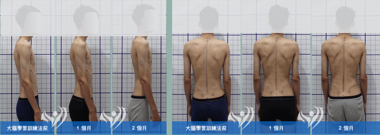 大腦學習訓練法矯正23歲僵硬型駝背伴隨姿勢型脊椎側彎