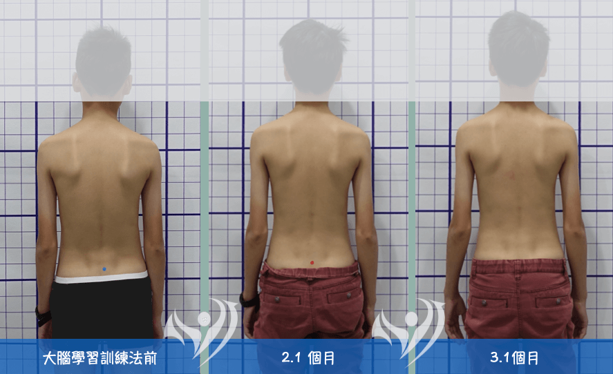 大腦學習訓練法改善11歲駝背及姿勢不良