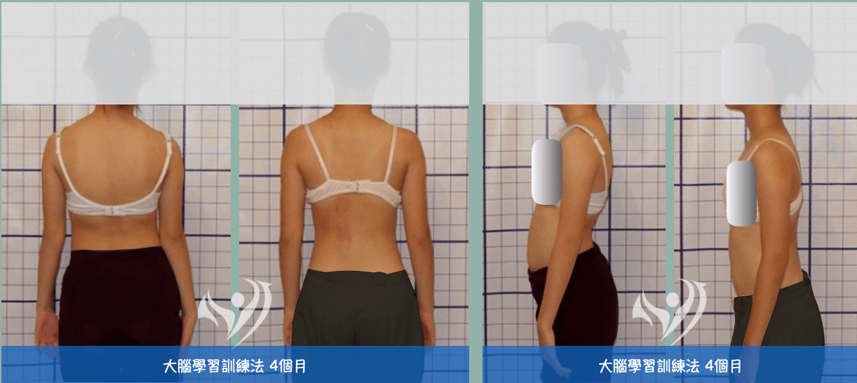 大腦學習訓練法4個月改善12歲駝背