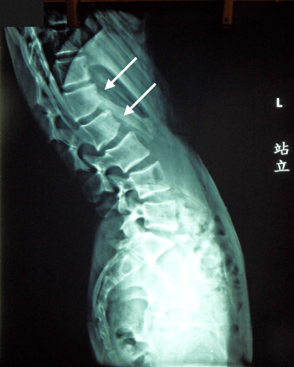 15歲男孩因駝背長期姿勢不良導致腰椎第一第二節擠壓變形
